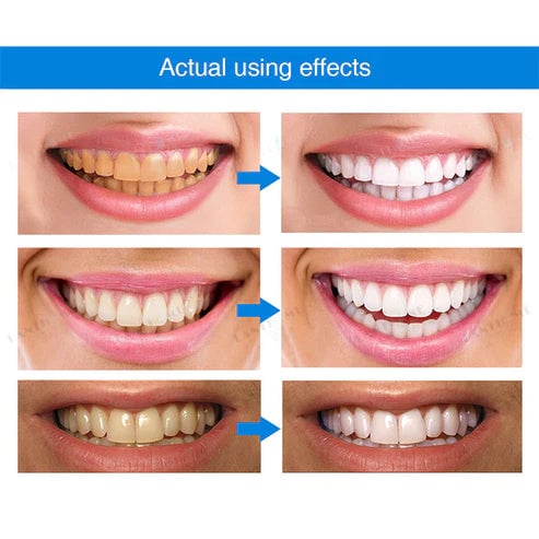 Teeth Whitening Essence For Bright And Sparkling Smile Care