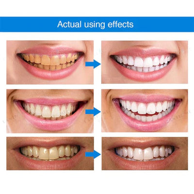 Teeth Whitening Essence For Bright And Sparkling Smile Care
