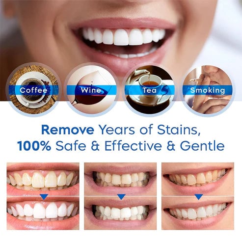 Teeth Whitening Essence For Bright And Sparkling Smile Care