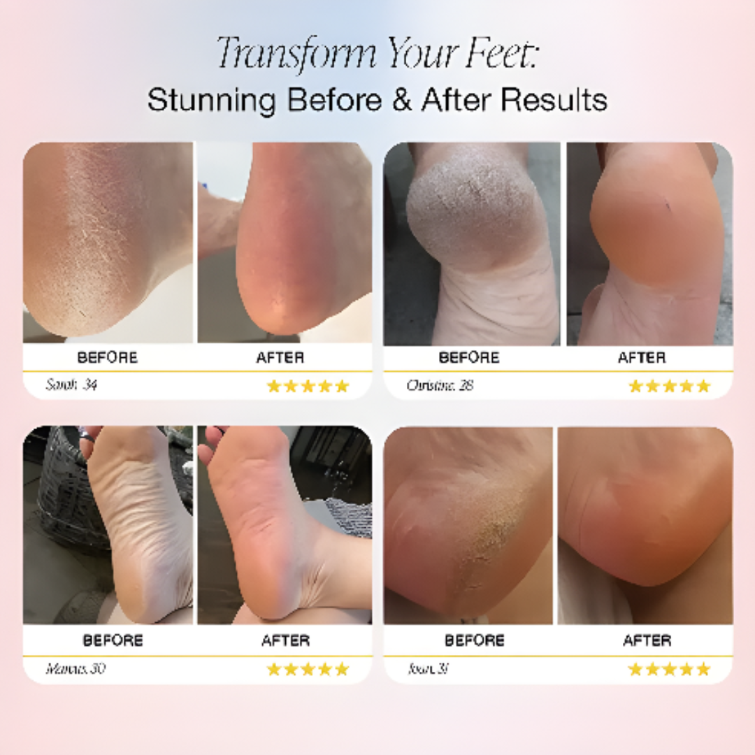 Electric Foot Callus Remover For Smooth Soft Feet Care