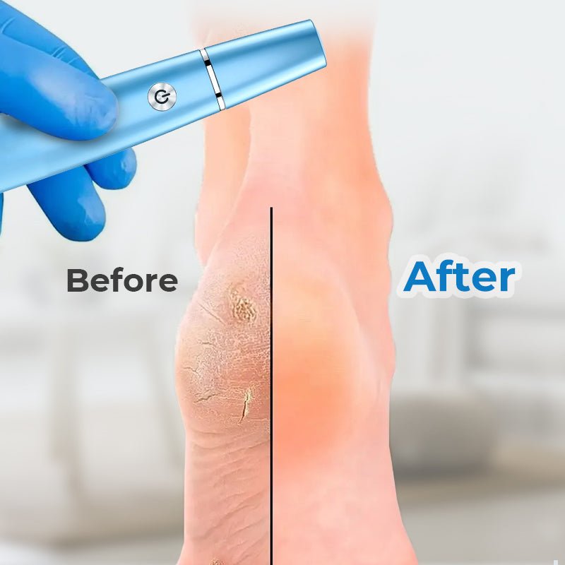 Electric Feet Callus Remover For Smooth Soft Foot Care Treatment