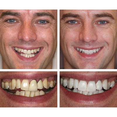 Teeth Whitening Essence For Bright And Sparkling Smile Care