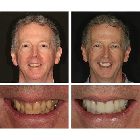 Teeth Whitening Essence For Bright And Sparkling Smile Care