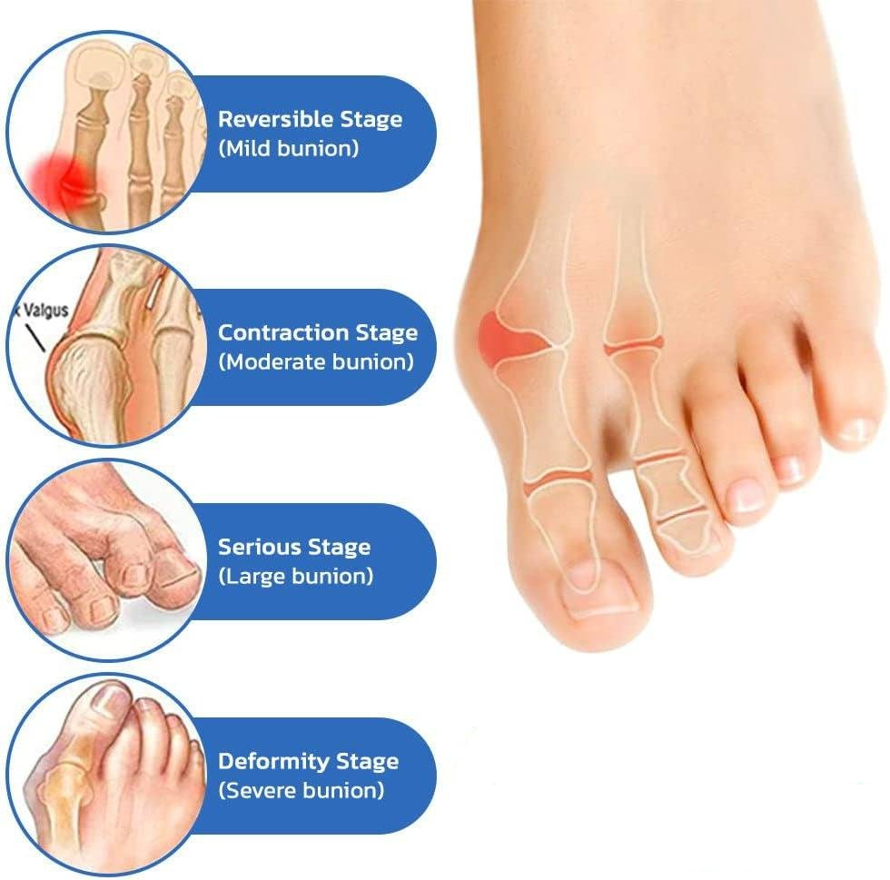 Anti Bunion Socks For Foot Pain Relief And Vein Support Unisex