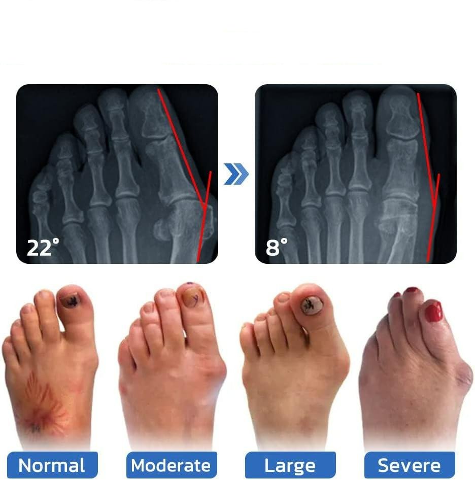 Anti Bunion Socks For Foot Pain Relief And Vein Support Unisex