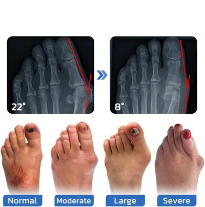 Anti Bunion Socks For Foot Pain Relief And Vein Support Unisex