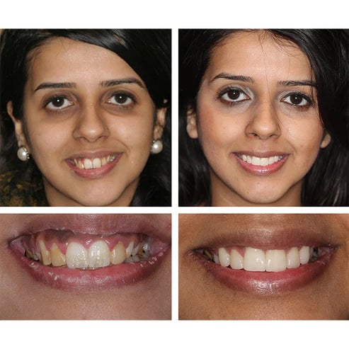 Teeth Whitening Essence For Bright And Sparkling Smile Care