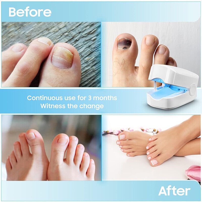 Nail Fungus Laser Device For Effective Toenail Light Therapy Treatment